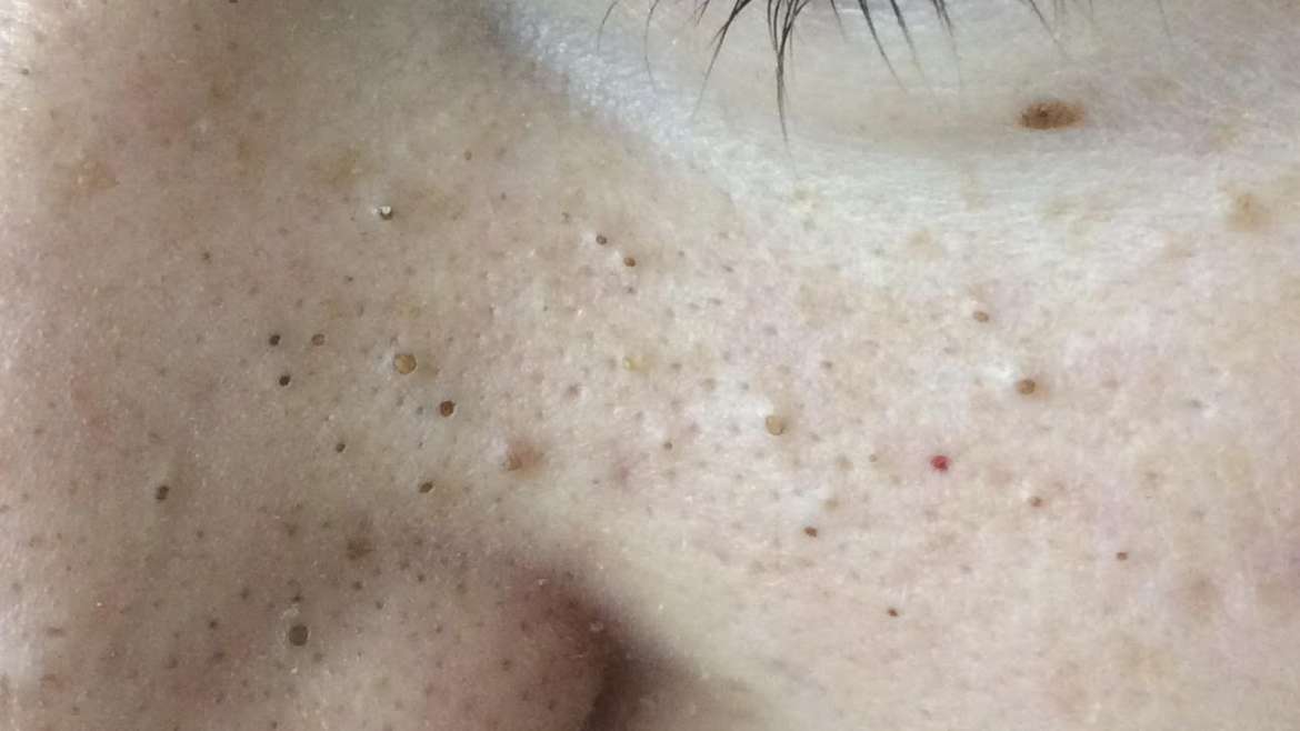 Najstniške akne – intervju z našo dermatologinjo