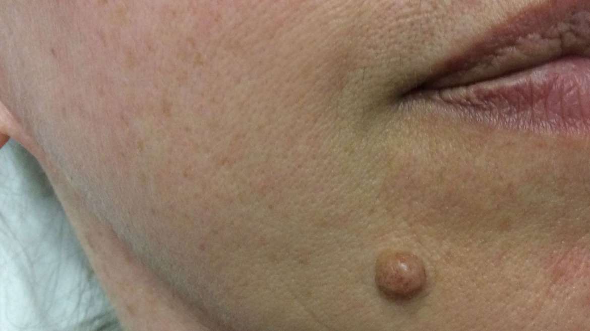 Navodila za paciente po odstranitvi kožnih izrastkov