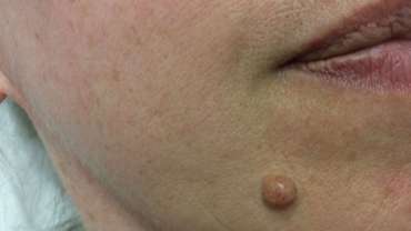 Navodila za paciente po odstranitvi kožnih izrastkov