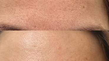 Kaj je boljše proti gubam na čelu, botoks ali laser?