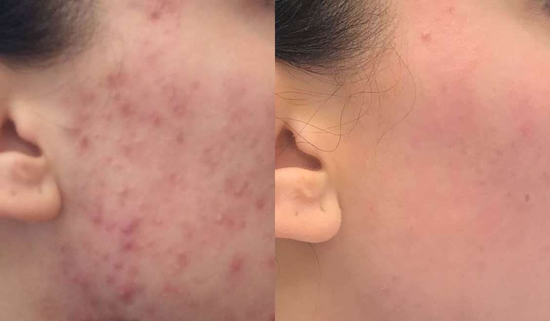 Dr. Vesna Tlaker: akne so bolezen kože, ki jo lahko učinkovito obvladamo