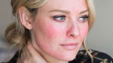 Rosacea: bolezen kože, ki jo lahko učinkovito ublažimo