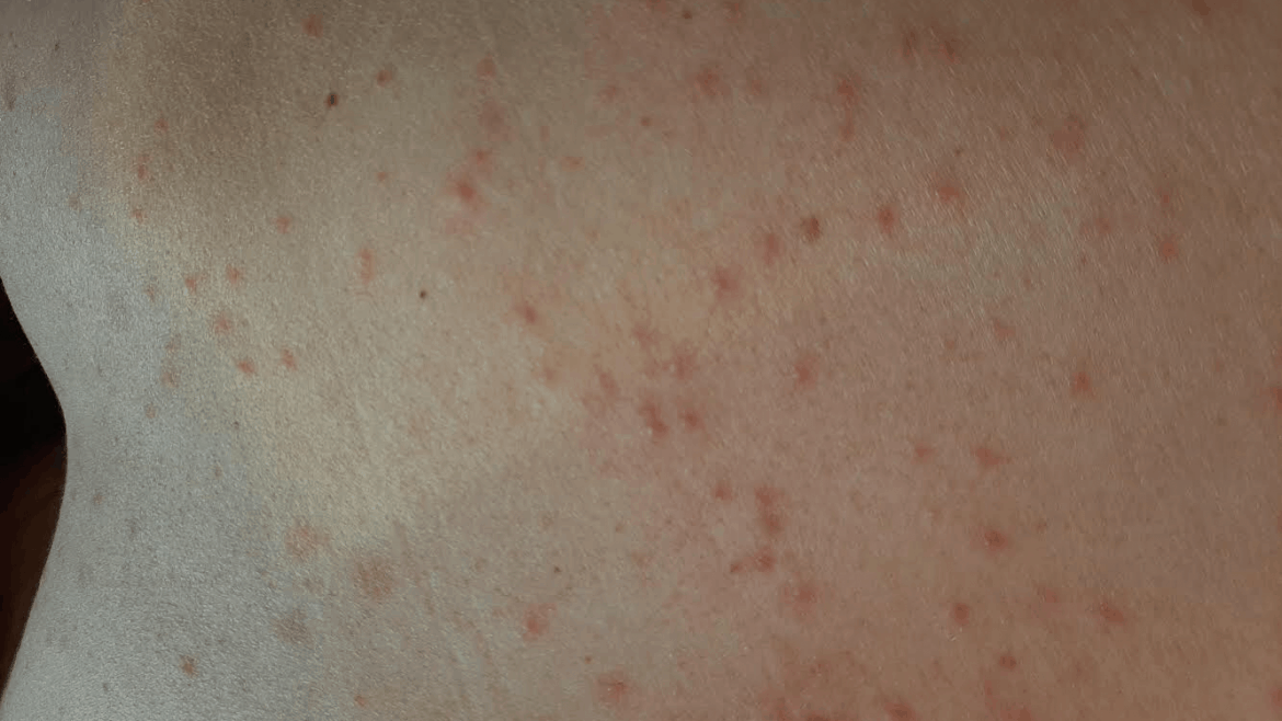 Trombidiaza – nenaden alergiji podoben izpuščaj