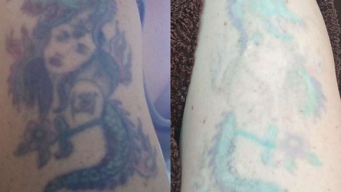 Multicolored tattoo removal – before (left) and after 9 months (right)