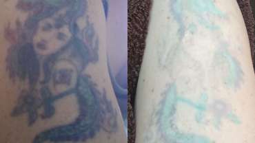 Multicolored tattoo removal – before (left) and after 9 months (right)