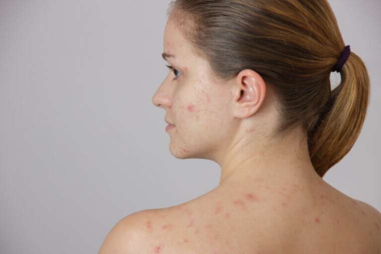 Retitren Izotretinoin, Roaccutane, Retitren, Accutane - Dermatologija.si