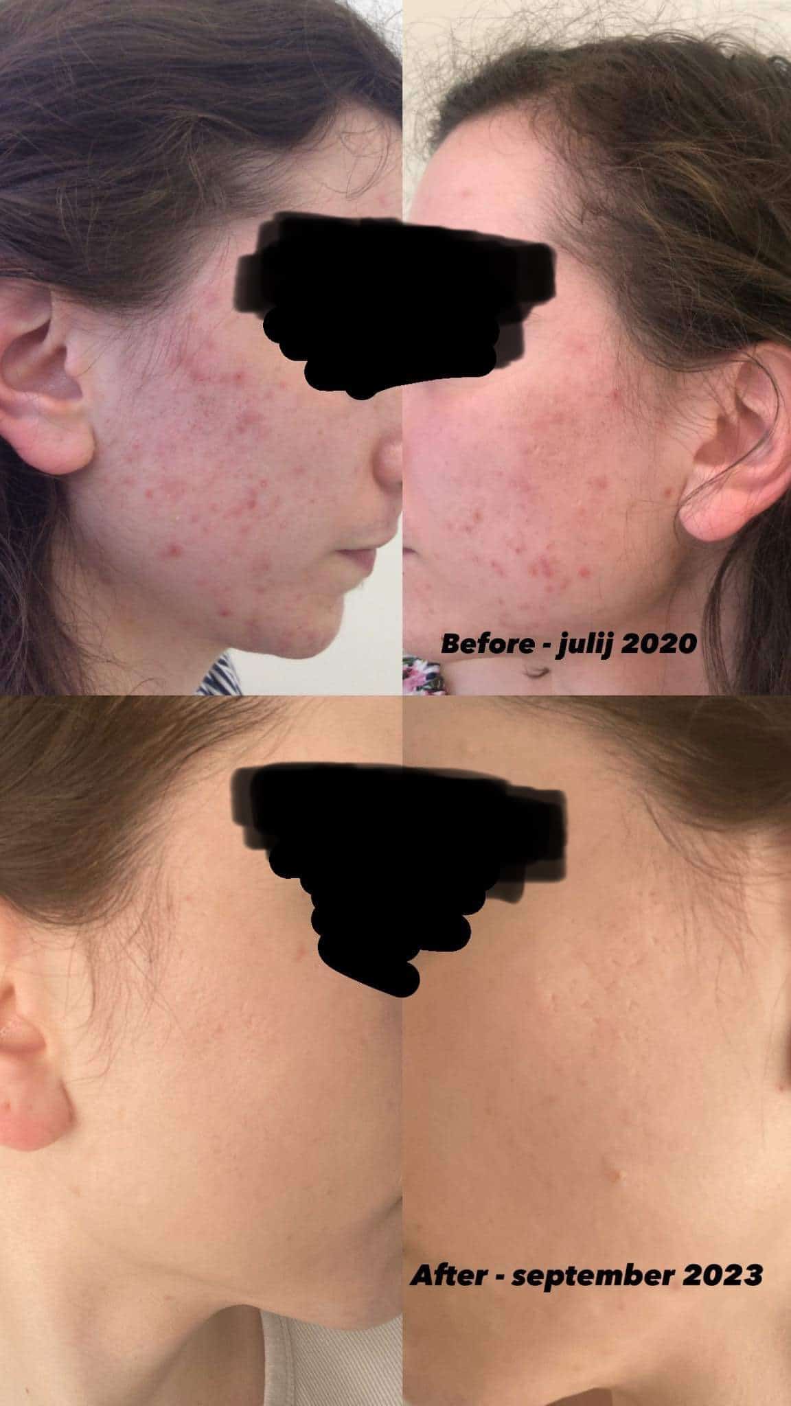 zdravljenje aken roaccutane retitren izotretinoin prej potem