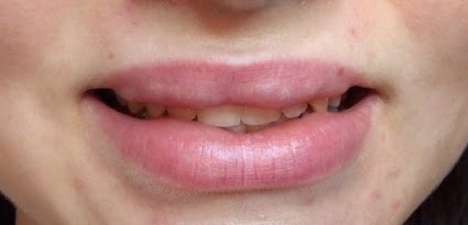 Bunkice zaradi filerja v ustnici