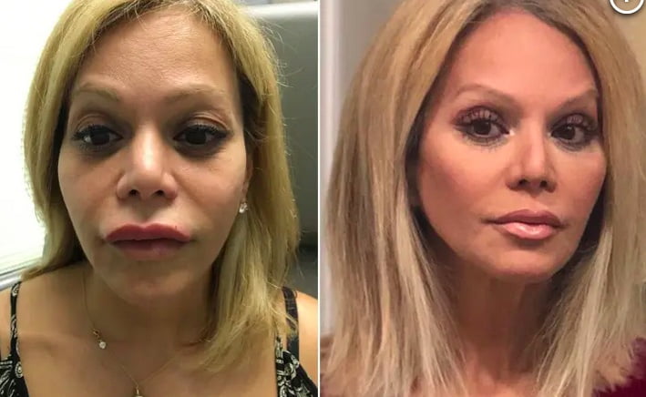 Prenapihnjen obraz zaradi hialuronskih polnil