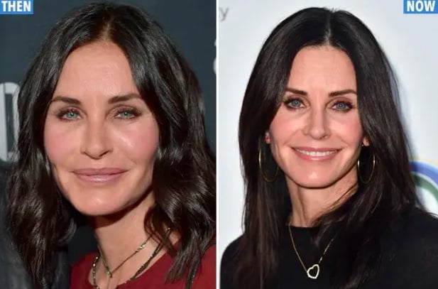 Preveč botoksa in polnil prej in potem, raztapljanje