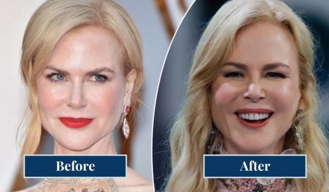 Preveč botoksa in preveč polnil prej in potem