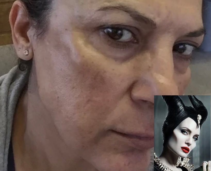 Preveč hialurona v ličnice neustrezna aplikacija hialuronskega polnila