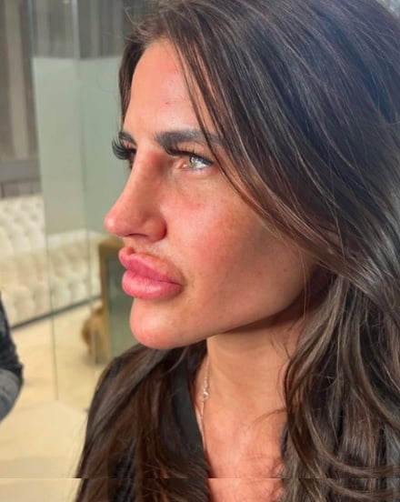 Preveč hialuronskega polnila ustnice, račje ustnice