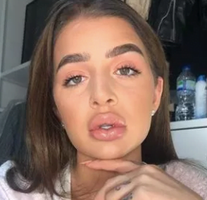 Preveč polnila ustnice neproporcionalno večja zgornja ustnica