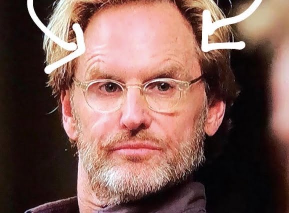 Spock oziroma Mefisto učinek zaradi botoksa v čelo - nenormalen dvig obrvi