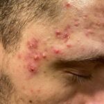 Akne na čelu in sencih pred terapijo: papule, pustule, komedoni.