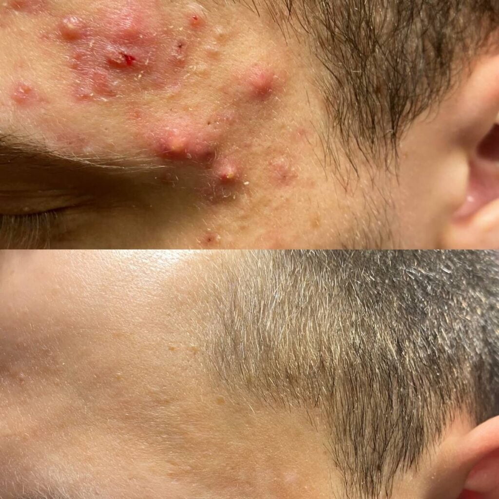 Dermatološki pregled za akne lahko pomaga zdraviti papulopustulozne akne na čelu pred terapijo (zgoraj) in po terapiji (spodaj)