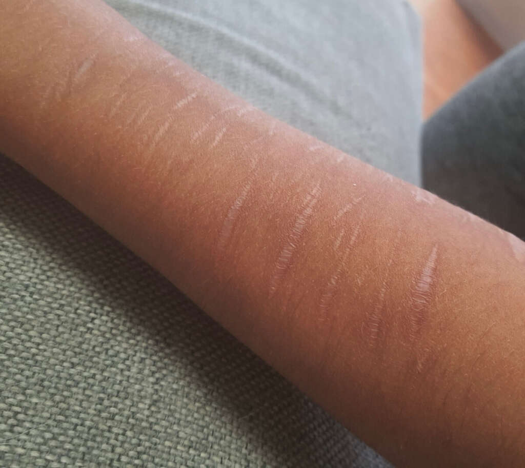 Brazgotine na podlakti zaradi samopoškodovanja