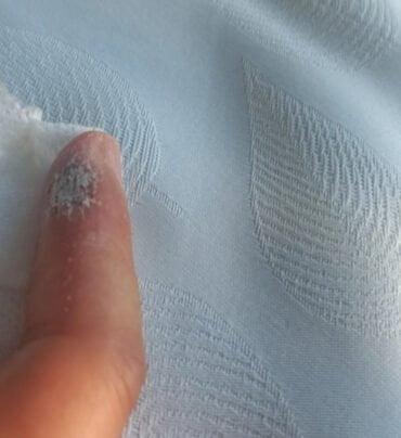 Piogeni granulom po laserski terapiji - celjenje. Rana je pokrita z antibiotičnim prahom.