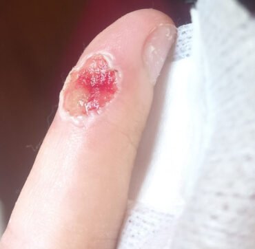 Piogeni granulom po laserski terapiji - rana takoj po posegu.