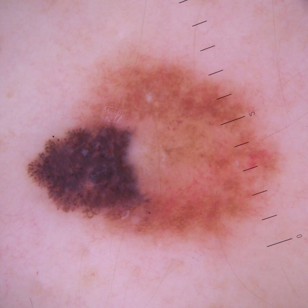 Melanom na hrbtu dermatoskopsko