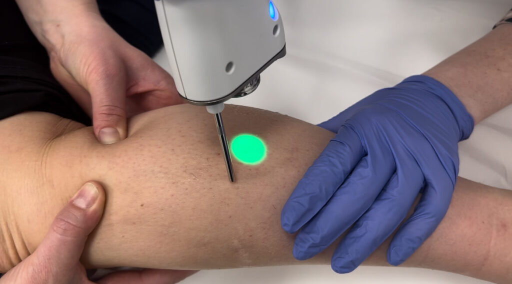 Lasersko odstranjevanje dlak