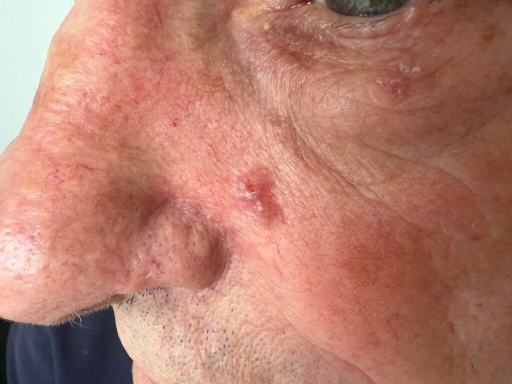 Bazalnocelični karcinom obraza