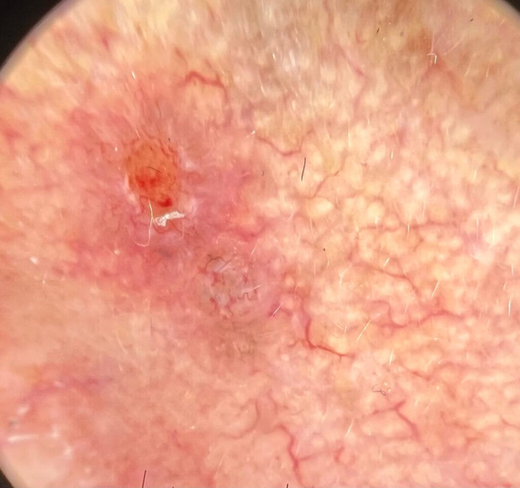 Bazalnocelični karcinom obraza dermatoskopsko