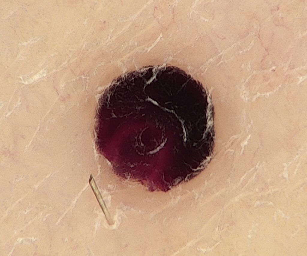 Hematom dermatoskopsko