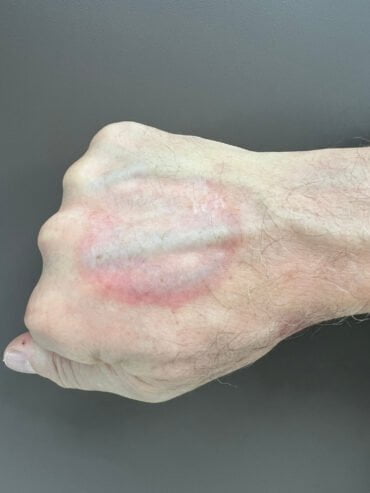 Granuloma annulare na hrbtišču roke