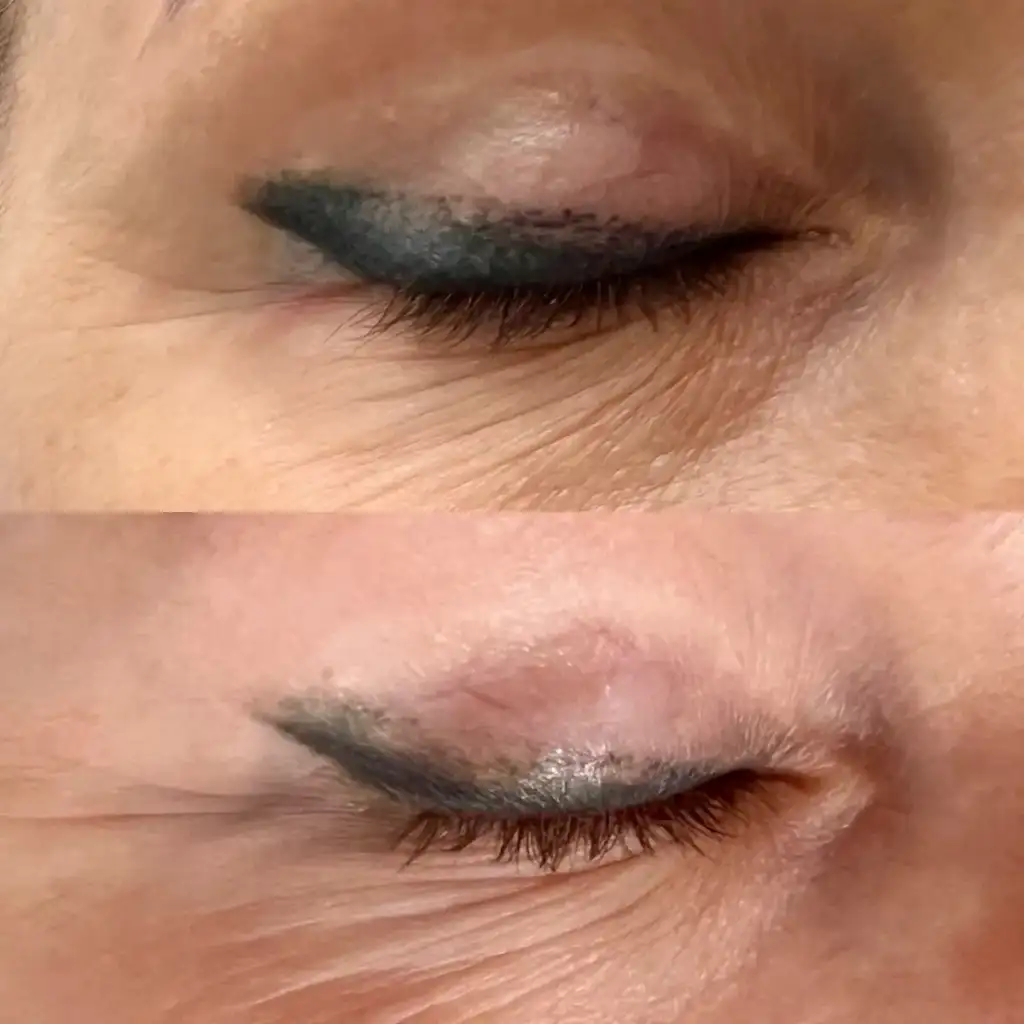 Lasersko odstranjevanje permanentnega makeupa eyelinerja črte nad očmi prej in potem