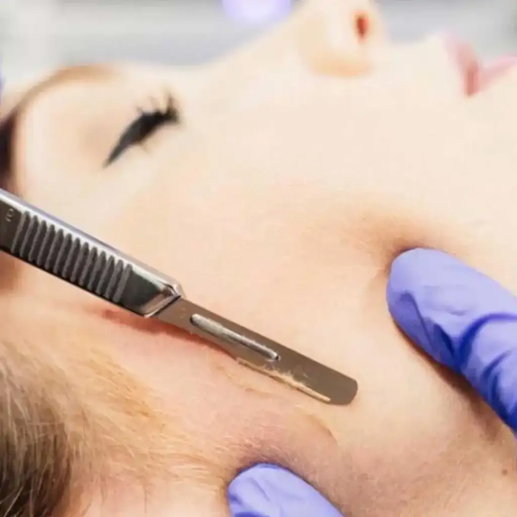 Dermaplaning, odstranjevanje puha na obrazu, odstranjevanje dlak na obrazu
