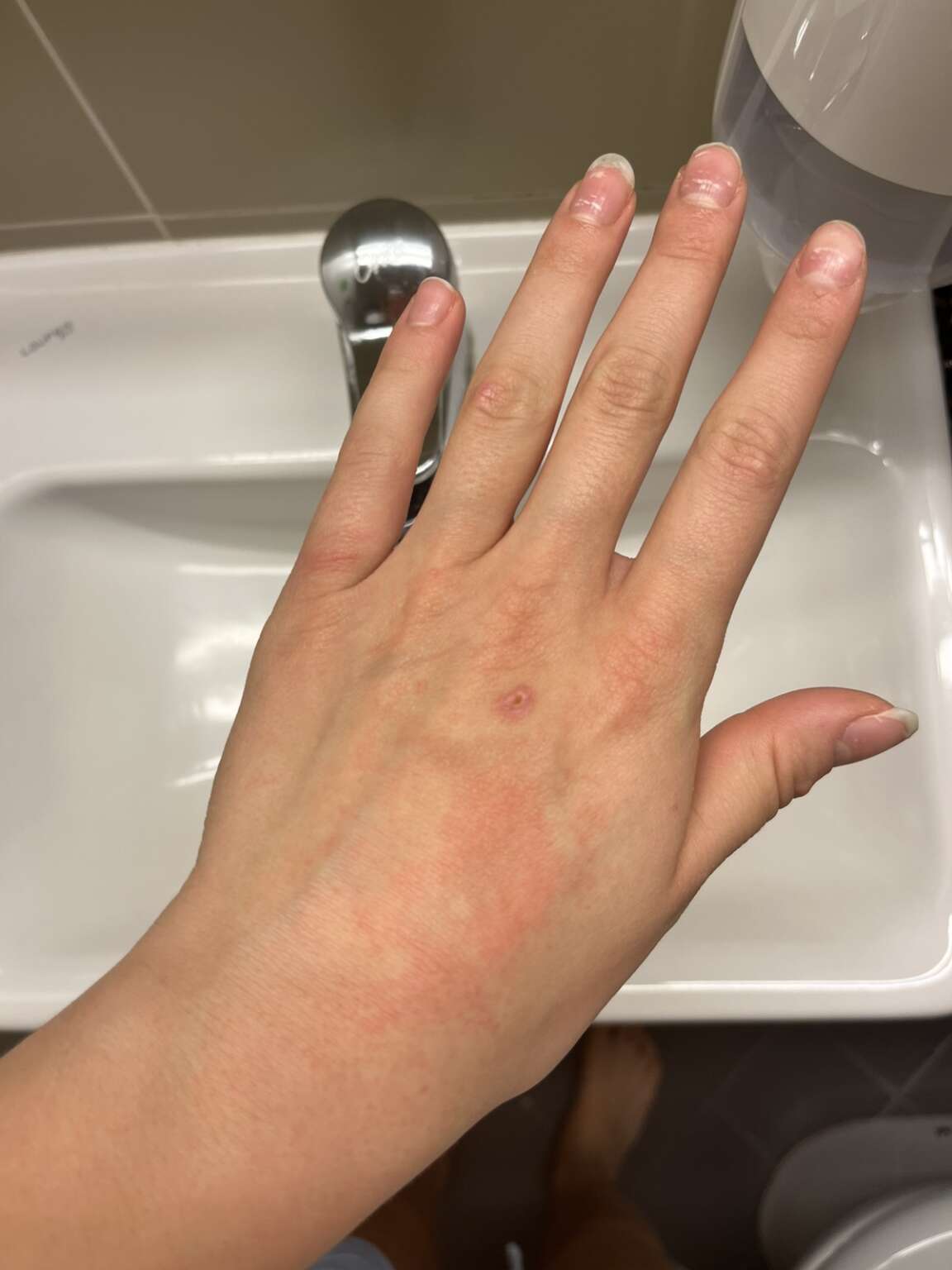 Retitren Forum - akne in Retitren (Roaccutane, izotretinoin) - Dermatologija.si