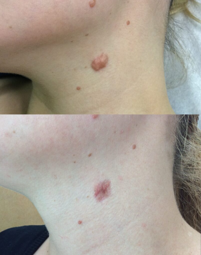 Hipertrofična brazgotina prej in po injekciji kortikosteroida