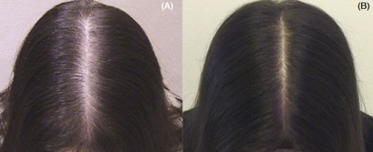 Microneedling mikronidling proti izpadanju las prej in potem