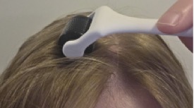 Mikronidling:microneedling lasišča proti izpadanju las
