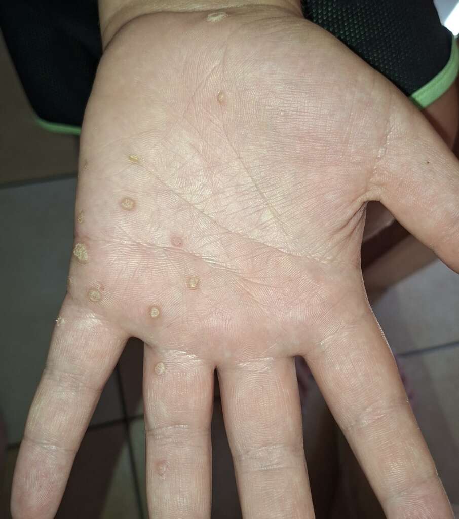 Virusne bradavice na rokah
